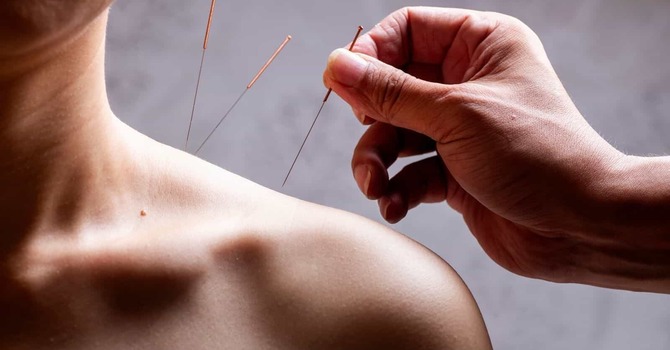 Acupuncture